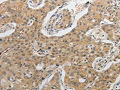 The image on the left is immunohistochemistry of paraffin-embedded Human lung cancer tissue using the antibody Antibody) at dilution 1/20, on the right is treated with fusion protein. (Original magnification: ×200)