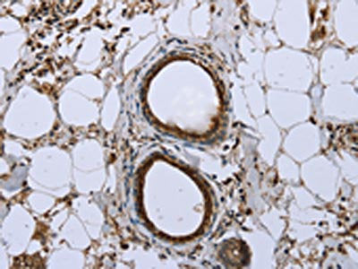 The image on the left is immunohistochemistry of paraffin-embedded Human breast cancer tissue using FBP1 Antibody(FBP1 Antibody) at dilution 1/40, on the right is treated with fusion protein. (Original magnification: ×200)Rabbit anti-Human FBP1 Polyclonal Antibody