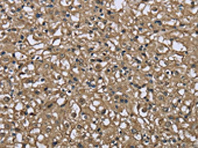 The image on the left is immunohistochemistry of paraffin-embedded Human prostate cancer tissue using the antibody Antibody) at dilution 1/40, on the right is treated with fusion protein. (Original magnification: ×200)Rabbit anti-Human FBP1 Polyclonal Antibody