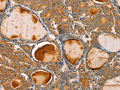 The image on the left is immunohistochemistry of paraffin-embedded Human thyroid cancer tissue using TRIM45 Antibody(TRIM45 Antibody) at dilution 1/25, on the right is treated with synthetic peptide. (Original magnification: ×200)Rabbit anti-Human TRIM45 Polyclonal Antibody