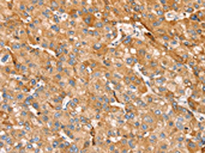 The image on the left is immunohistochemistry of paraffin-embedded Human liver cancer tissue using the antibody Antibody) at dilution 1/25, on the right is treated with synthetic peptide. (Original magnification: ×200)Rabbit anti-Human TRIM45 Polyclonal Antibody