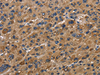 The image on the left is immunohistochemistry of paraffin-embedded Human liver cancer tissue using the antibody Antibody) at dilution 1/40, on the right is treated with synthetic peptide. (Original magnification: ×200)Rabbit anti-Human FABP2 Polyclonal Antibody
