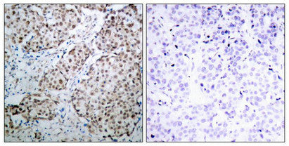 Immunohistochemical analysis of paraffin-embedded human breast carcinoma tissue using p53(Phospho-Ser315) Antibody(left) or the same antibody preincubated with blocking peptide(right).Rabbit anti-Human TP53 Polyclonal Antibody
