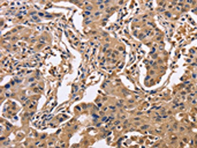 The image on the left is immunohistochemistry of paraffin-embedded Human lung cancer tissue using IDH1 Antibody(IDH1 Antibody) at dilution 1/50, on the right is treated with fusion protein. (Original magnification: ×200)Rabbit anti-Human IDH1 Polyclonal Antibody