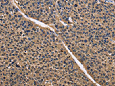 The image on the left is immunohistochemistry of paraffin-embedded Human liver cancer tissue using the antibody Antibody) at dilution 1/50, on the right is treated with fusion protein. (Original magnification: ×200)Rabbit anti-Human IDH1 Polyclonal Antibody