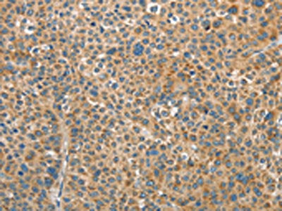 The image on the left is immunohistochemistry of paraffin-embedded Human liver cancer tissue using RAP1A Antibody(RAP1A Antibody) at dilution 1/35, on the right is treated with fusion protein. (Original magnification: ×200)Rabbit anti-Human RAP1A Polyclonal Antibody