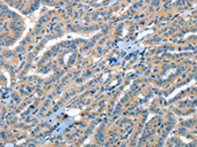 The image on the left is immunohistochemistry of paraffin-embedded Human thyroid cancer tissue using the antibody Antibody) at dilution 1/35, on the right is treated with fusion protein. (Original magnification: ×200)Rabbit anti-Human RAP1A Polyclonal Antibody