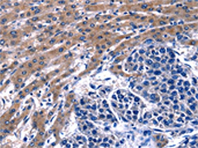 The image on the left is immunohistochemistry of paraffin-embedded Human liver cancer tissue using GIP Antibody(GIP Antibody) at dilution 1/13, on the right is treated with fusion protein. (Original magnification: ×200)Rabbit anti-Human GIP Polyclonal Antibody
