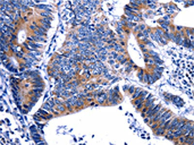 The image on the left is immunohistochemistry of paraffin-embedded Human colon cancer tissue using the antibody Antibody) at dilution 1/13, on the right is treated with fusion protein. (Original magnification: ×200)Rabbit anti-Human GIP Polyclonal Antibody