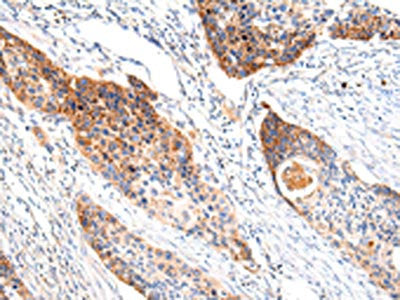 The image on the left is immunohistochemistry of paraffin-embedded Human esophagus cancer tissue using IGLV1-51 Antibody(Lambda Light chain Antibody) at dilution 1/20, on the right is treated with synthetic peptide. (Original magnification: ×200)Rabbit anti-Human IGLV1-51 Polyclonal Antibody