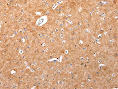 The image on the left is immunohistochemistry of paraffin-embedded Human brain tissue using the antibody Light chain Antibody) at dilution 1/20, on the right is treated with synthetic peptide. (Original magnification: ×200)Rabbit anti-Human IGLV1-51 Polyclonal Antibody