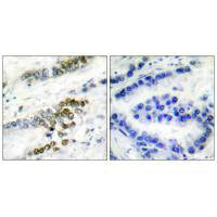 Immunohistochemical analysis of paraffin-embedded human lung carcinoma tissue using ERCC1 antibody.Rabbit anti-Human ERCC1 Polyclonal Antibody