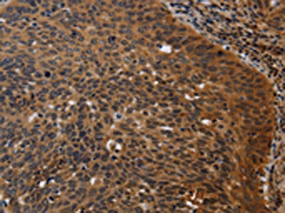 The image on the left is immunohistochemistry of paraffin-embedded Human cervical cancer tissue using FGB Antibody(FGB Antibody) at dilution 1/20, on the right is treated with fusion protein. (Original magnification: ×200)Rabbit anti-Human FGB Polyclonal Antibody