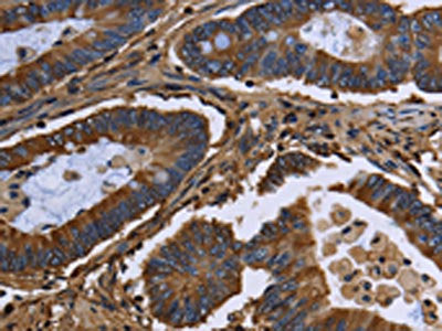 The image on the left is immunohistochemistry of paraffin-embedded Human colon cancer tissue using the antibody Antibody) at dilution 1/20, on the right is treated with fusion protein. (Original magnification: ×200)Rabbit anti-Human FGB Polyclonal Antibody