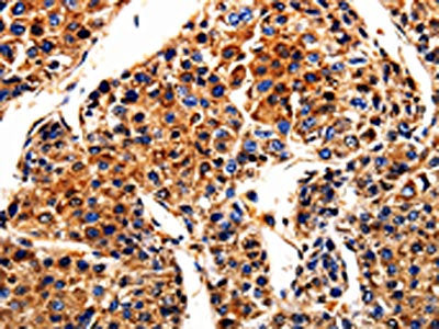 The image is immunohistochemistry of paraffin-embedded Human liver cancer tissue using APLP1 Antibody(APLP1 Antibody) at dilution 1/10. (Original magnification: ×200)Rabbit anti-Human APLP1 Polyclonal Antibody