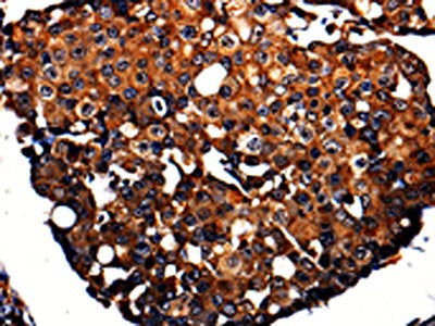 The image is immunohistochemistry of paraffin-embedded Human breast cancer tissue using the antibody Antibody) at dilution 1/10. (Original magnification: ×200)Rabbit anti-Human APLP1 Polyclonal Antibody