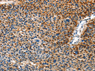 The image on the left is immunohistochemistry of paraffin-embedded Human liver cancer tissue using AMDHD2 Antibody(AMDHD2 Antibody) at dilution 1/40, on the right is treated with fusion protein. (Original magnification: ×200)Rabbit anti-Human AMDHD2 Polyclonal Antibody