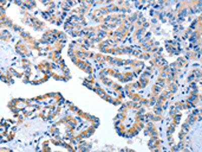 The image on the left is immunohistochemistry of paraffin-embedded Human thyroid cancer tissue using the antibody Antibody) at dilution 1/40, on the right is treated with fusion protein. (Original magnification: ×200)Rabbit anti-Human AMDHD2 Polyclonal Antibody