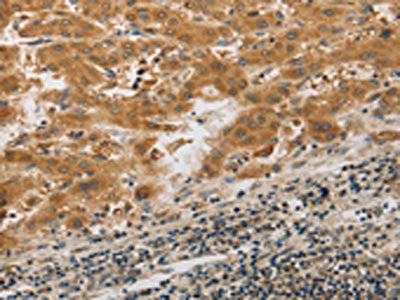 The image on the left is immunohistochemistry of paraffin-embedded Human liver cancer tissue using PIBF1 Antibody(PIBF1 Antibody) at dilution 1/20, on the right is treated with synthetic peptide. (Original magnification: ×200)Rabbit anti-Human PIBF1 Polyclonal Antibody