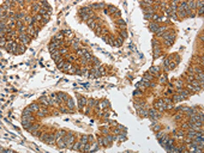 The image on the left is immunohistochemistry of paraffin-embedded Human colon cancer tissue using the antibody Antibody) at dilution 1/20, on the right is treated with synthetic peptide. (Original magnification: ×200)Rabbit anti-Human PIBF1 Polyclonal Antibody