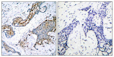 Immunohistochemical analysis of paraffin-embedded human breast carcinoma tissue using Estrogen Receptor-a(Phospho-Ser118) Antibody(left) or the same antibody preincubated with blocking peptide(right).Rabbit anti-Human ESR1 Polyclonal Antibody