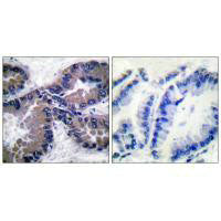 Immunohistochemical analysis of paraffin-embedded human lung carcinoma tissue using NRF2 antibody.Rabbit anti-Human NFE2L2 Polyclonal Antibody