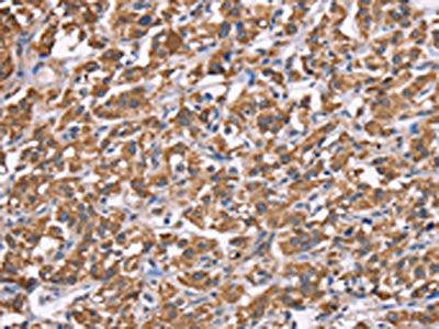 The image on the left is immunohistochemistry of paraffin-embedded Human thyroid cancer tissue using HSPE1 Antibody(HSPE1 Antibody) at dilution 1/40, on the right is treated with synthetic peptide. (Original magnification: ×200)Rabbit anti-Human HSPE1 Polyclonal Antibody