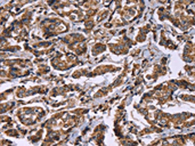 The image on the left is immunohistochemistry of paraffin-embedded Human breast cancer tissue using the antibody Antibody) at dilution 1/40, on the right is treated with synthetic peptide. (Original magnification: ×200)Rabbit anti-Human HSPE1 Polyclonal Antibody