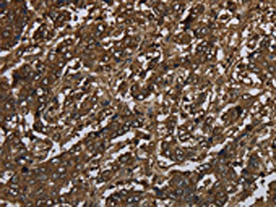 The image on the left is immunohistochemistry of paraffin-embedded Human liver cancer tissue using the antibody Antibody) at dilution 1/60, on the right is treated with fusion protein. (Original magnification: ×200)Rabbit anti-Human GLO1 Polyclonal Antibody