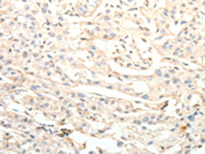 The image on the left is immunohistochemistry of paraffin-embedded Human lung cancer tissue using BIRC2 Antibody(BIRC2 Antibody) at dilution 1/20, on the right is treated with fusion protein. (Original magnification: ×200)