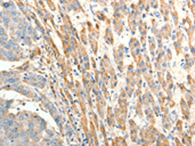 The image on the left is immunohistochemistry of paraffin-embedded Human liver cancer tissue using the antibody Antibody) at dilution 1/20, on the right is treated with fusion protein. (Original magnification: ×200)