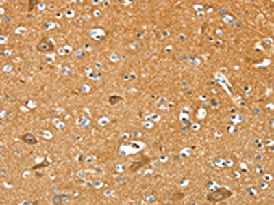 The image on the left is immunohistochemistry of paraffin-embedded Human brain  tissue using PYGL Antibody(PYGL Antibody) at dilution 1/35, on the right is treated with fusion protein. (Original magnification: ×200)Rabbit anti-Human PYGL Polyclonal Antibody