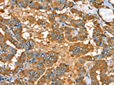 The image on the left is immunohistochemistry of paraffin-embedded Human thyroid cancer tissue using the antibody Antibody) at dilution 1/35, on the right is treated with fusion protein. (Original magnification: ×200)Rabbit anti-Human PYGL Polyclonal Antibody