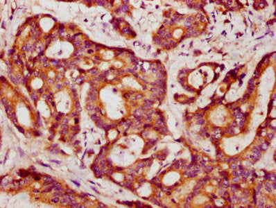 IHC image of PPP2R1B Antibody diluted at 1:403 and staining in paraffin-embedded human colon cancer performed on a Leica BondTM system. After dewaxing and hydration, antigen retrieval was mediated by high pressure in a citrate buffer (pH 6.0). Section was blocked with 10% normal goat serum 30min at RT. Then primary antibody (1% BSA) was incubated at 4°C overnight. The primary is detected by a biotinylated secondary antibody and visualized using an HRP conjugated SP system.Rabbit anti-Human PPP2R1B Polyclonal Antibody