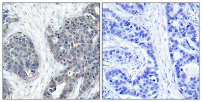 Immunohistochemical analysis of paraffin-embedded human breast carcinoma tissue using Stathmin 1(Ab-38) Antibody(left) or the same antibody preincubated with blocking peptide(right).Rabbit anti-Human STMN1 Polyclonal Antibody