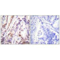 Immunohistochemical analysis of paraffin-embedded human lung carcinoma tissue using HDAC9 antibody.Rabbit anti-Human HDAC9 Polyclonal Antibody