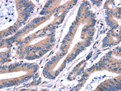 The image on the left is immunohistochemistry of paraffin-embedded Human colon cancer tissue using ARRB1 Antibody(ARRB1 Antibody) at dilution 1/15, on the right is treated with synthetic peptide. (Original magnification: ×200)Rabbit anti-Human ARRB1 Polyclonal Antibody
