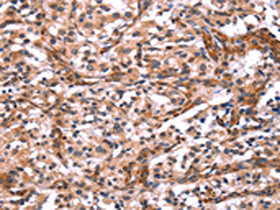 The image on the left is immunohistochemistry of paraffin-embedded Human thyroid cancer tissue using the antibody Antibody) at dilution 1/15, on the right is treated with synthetic peptide. (Original magnification: ×200)Rabbit anti-Human ARRB1 Polyclonal Antibody