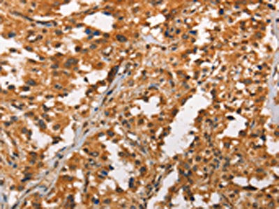 The image on the left is immunohistochemistry of paraffin-embedded Human thyroid cancer tissue using CRKL Antibody(CRKL Antibody) at dilution 1/25, on the right is treated with synthetic peptide. (Original magnification: ×200)Rabbit anti-Human CRKL Polyclonal Antibody