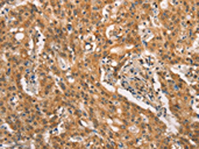The image on the left is immunohistochemistry of paraffin-embedded Human gastic cancer tissue using the antibody Antibody) at dilution 1/25, on the right is treated with synthetic peptide. (Original magnification: ×200)Rabbit anti-Human CRKL Polyclonal Antibody