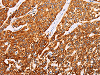 The image on the left is immunohistochemistry of paraffin-embedded Human esophagus cancer tissue using SYVN1 Antibody(SYVN1 Antibody) at dilution 1/10, on the right is treated with fusion protein. (Original magnification: ×200)Rabbit anti-Human SYVN1 Polyclonal Antibody