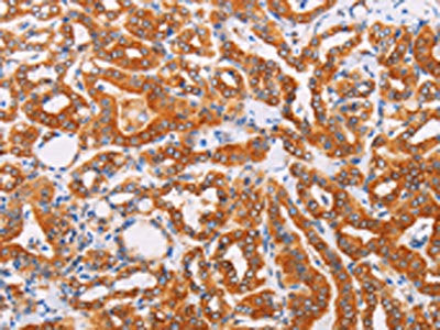 The image on the left is immunohistochemistry of paraffin-embedded Human thyroid cancer tissue using the antibody Antibody) at dilution 1/10, on the right is treated with fusion protein. (Original magnification: ×200)Rabbit anti-Human SYVN1 Polyclonal Antibody