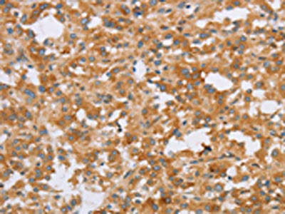 The image on the left is immunohistochemistry of paraffin-embedded Human thyroid cancer tissue using CRELD2 Antibody(CRELD2 Antibody) at dilution 1/40, on the right is treated with fusion protein. (Original magnification: ×200)Rabbit anti-Human CRELD2 Polyclonal Antibody