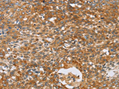 The image on the left is immunohistochemistry of paraffin-embedded Human cervical cancer tissue using the antibody Antibody) at dilution 1/40, on the right is treated with fusion protein. (Original magnification: ×200)Rabbit anti-Human CRELD2 Polyclonal Antibody