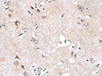 The image on the left is immunohistochemistry of paraffin-embedded Human brain tissue using ADRB3 Antibody(ADRB3 Antibody) at dilution 1/25, on the right is treated with synthetic peptide. (Original magnification: ×200)Rabbit anti-Human ADRB3 Polyclonal Antibody