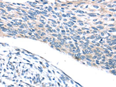 The image on the left is immunohistochemistry of paraffin-embedded Human esophagus cancer tissue using the antibody Antibody) at dilution 1/25, on the right is treated with synthetic peptide. (Original magnification: ×200)