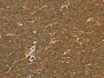 The image on the left is immunohistochemistry of paraffin-embedded Human lymphoma tissue using APOL2 Antibody(APOL2 Antibody) at dilution 1/80, on the right is treated with synthetic peptide. (Original magnification: ×200)Rabbit anti-Human APOL2 Polyclonal Antibody