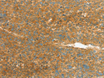 The image on the left is immunohistochemistry of paraffin-embedded Human liver cancer tissue using the antibody Antibody) at dilution 1/80, on the right is treated with synthetic peptide. (Original magnification: ×200)Rabbit anti-Human APOL2 Polyclonal Antibody