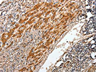 The image on the left is immunohistochemistry of paraffin-embedded Human liver cancer tissue using BCL2 Antibody(BCL2 Antibody) at dilution 1/20, on the right is treated with synthetic peptide. (Original magnification: ×200)