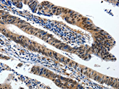 The image on the left is immunohistochemistry of paraffin-embedded Human colorectal cancer tissue using the antibody Antibody) at dilution 1/20, on the right is treated with synthetic peptide. (Original magnification: ×200)